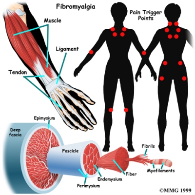 Fibromyalgia | Central Orthopedic Group