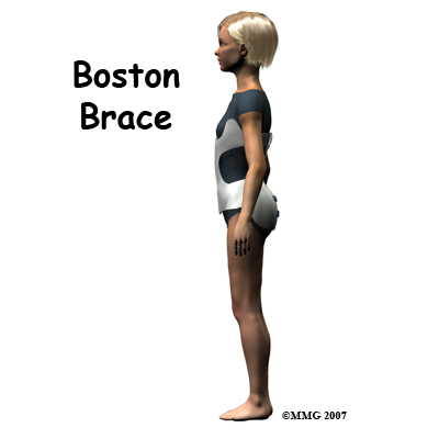Резултат с изображение за boston brace scoliosis in kids