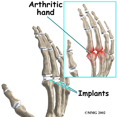 finger_arthroplasty_surg01