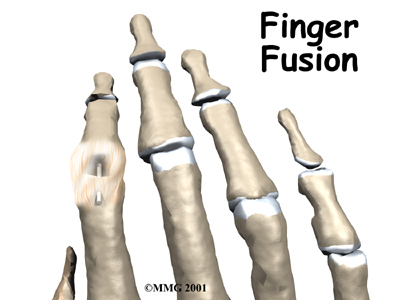 finger_fusion_intro01