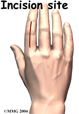 finger_fusion_surg01