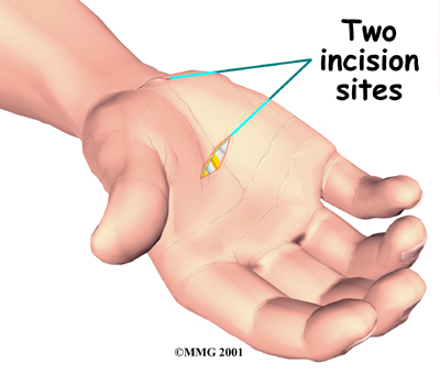 hand_cts_endoscopic_surgery01