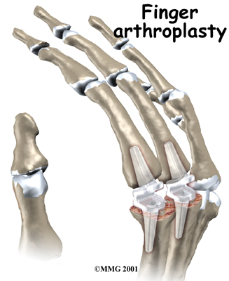 hand_finger_joint_treatment02