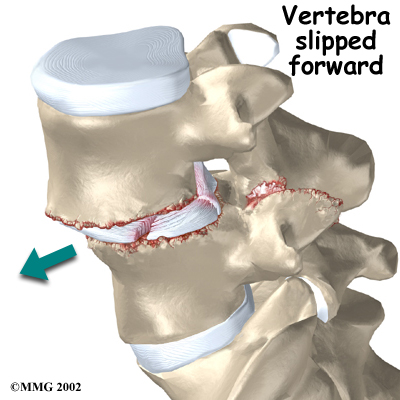 spondylothesis pain spondylothesis pain