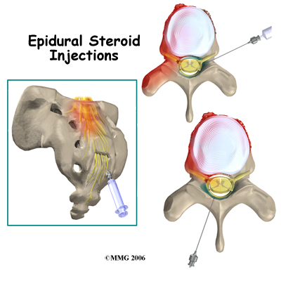 Caudal epidural steroid injection results
