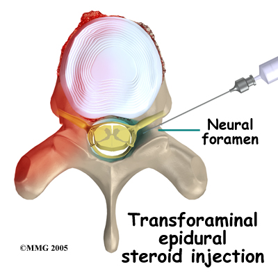 Transforaminal epidural steroid injection vs selective nerve root block