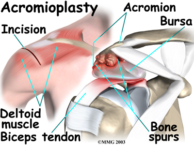 Steroid injection in bicep tendon