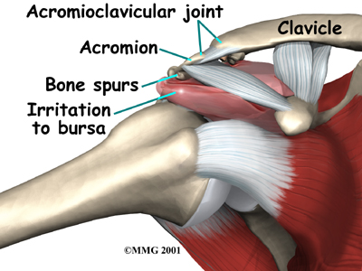shoulder_impingement_causes01