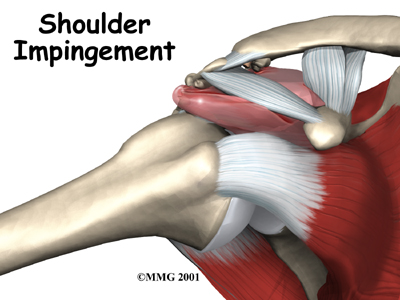 shoulder_impingement_intro01