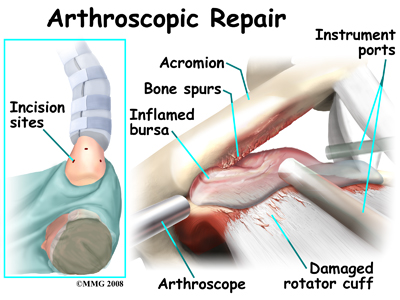 shoulder_impingement_surgery01