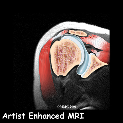 shoulder_rotator_cuff_diagnosis02