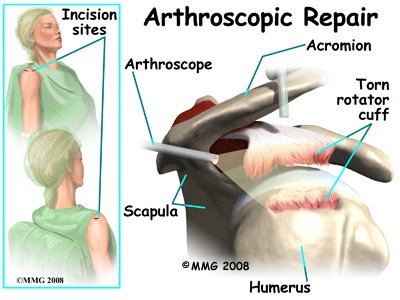 shoulder_rotator_cuff_treatment08