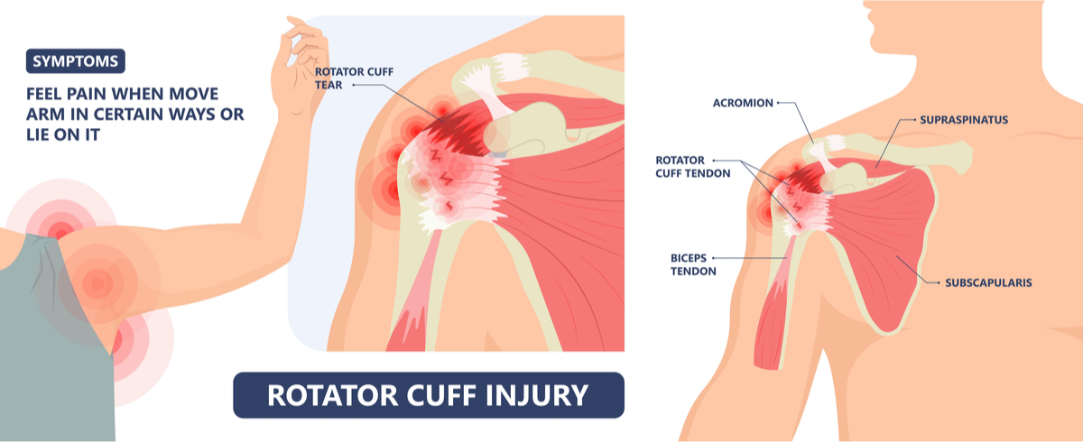 vector diagram of rotator cuff injury and symptoms