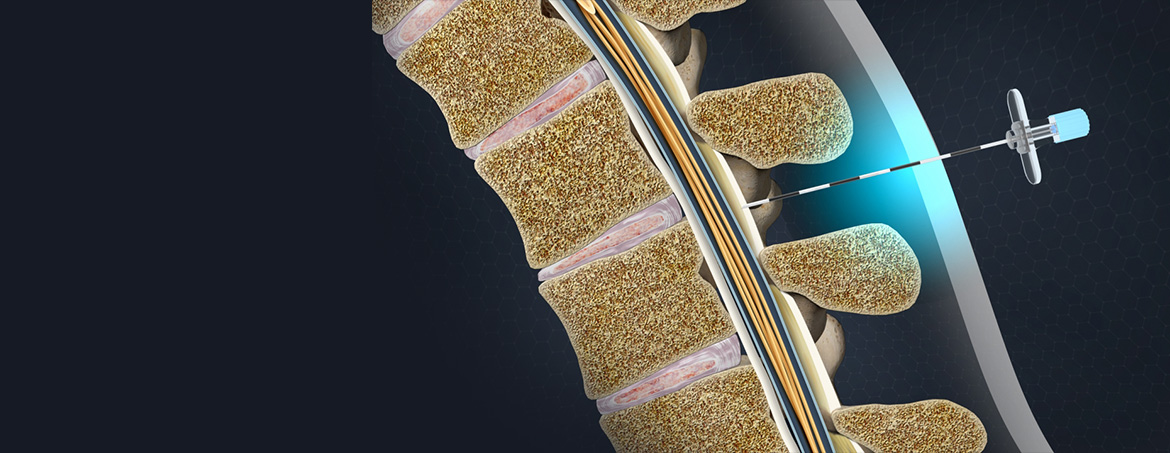skeletal spine graphic with needle showing pain management