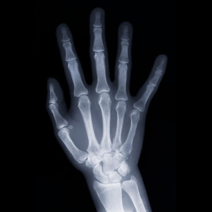 x-ray of a hand