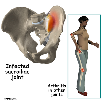 SI_joint_causes01