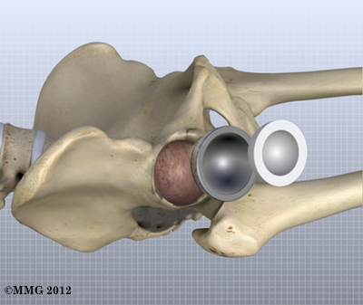 THR_Anterior_Acetabular_Insert_14