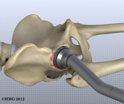 THR_Anterior_Acetabular_Ream_13