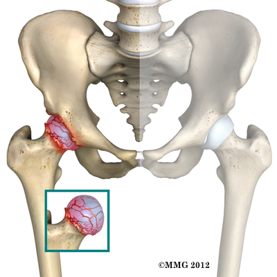 THR_Anterior_Arthritis_03