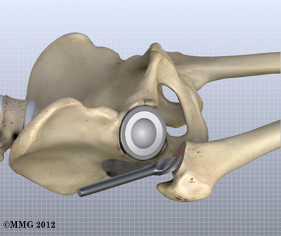 THR_Anterior_Femoral_Drill_16