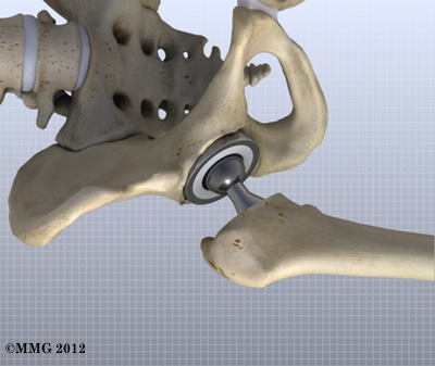 THR_Anterior_Femoral_ROM_21