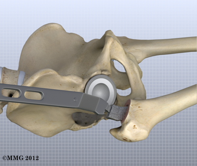 THR_Anterior_Femoral_Rasp_17_001