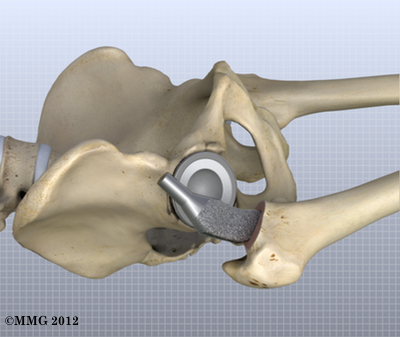 THR_Anterior_Femoral_Stem_18