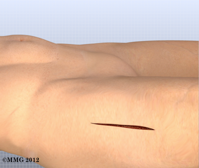 THR_Anterior_Incision_08