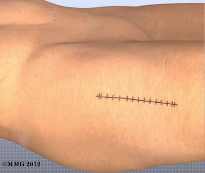 THR_Anterior_Incision_Closed_22