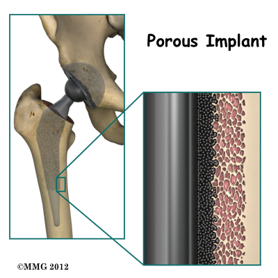 THR_Anterior_Porous_Implant_05