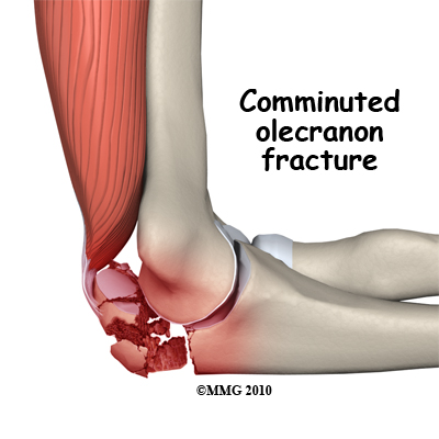adult_elbow_fx_olecranon_comminuted