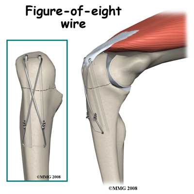 adult_elbow_fx_olecranon_figure_eight_wire