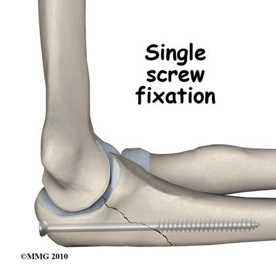 adult_elbow_fx_olecranon_single_screw