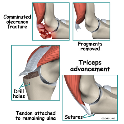 adult_fx_olecranon_triceps_advancement