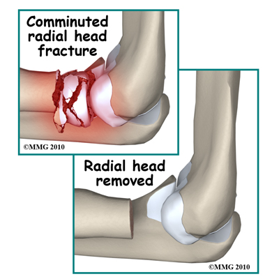 adult_elbow_fx_radial_head_excision