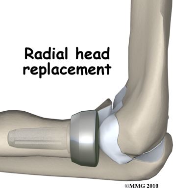 adult_elbow_fx_radial_head_replacement