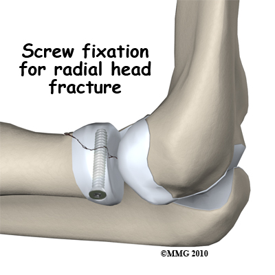 adult_elbow_fx_radial_head_screw