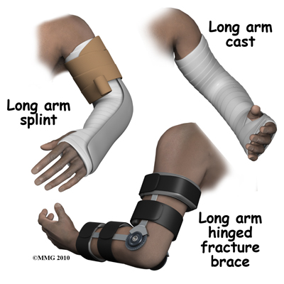 adult_elbow_fx_splint_cast_brace