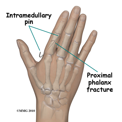 adult_finger_fx_IM_pin