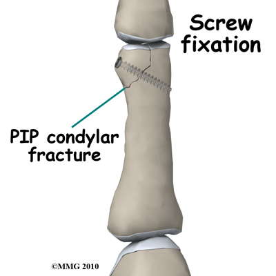 adult_finger_fx_PIP_condyle_screw