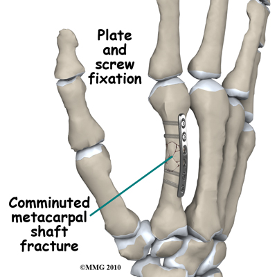 adult_finger_fx_metacarpal_plate