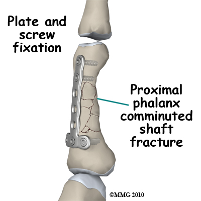 adult_finger_fx_plate