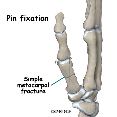 adult_finger_fx_thumb_metacarpal_pins