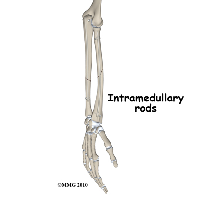 adult_forearm_fx_IM_rod
