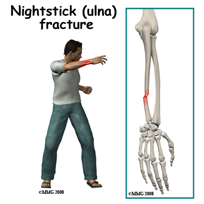 adult_forearm_fx_causes01