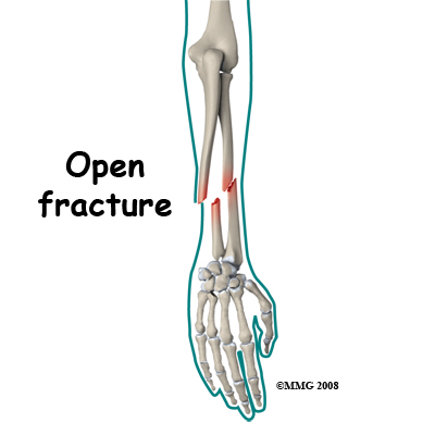 adult_forearm_fx_causes02