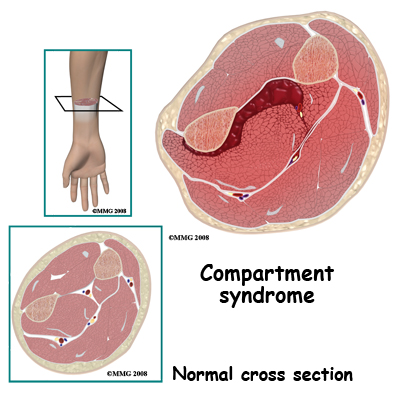 adult_forearm_fx_complication01