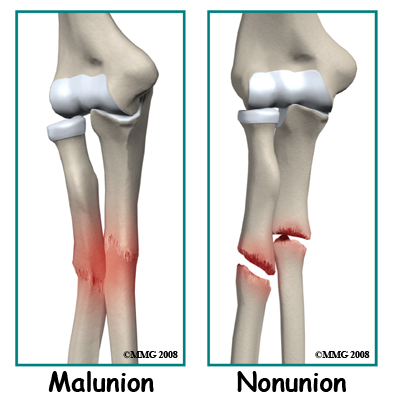 adult_forearm_fx_complication02