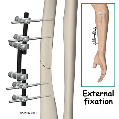 adult_forearm_fx_external_fixation