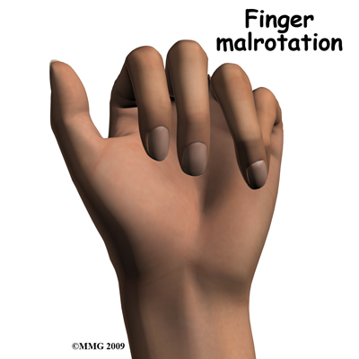 adult_hand_fx_complications01